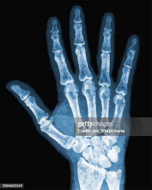 72 Right Hand X Ray Stock Photos, High-Res Pictures, and Images ...
