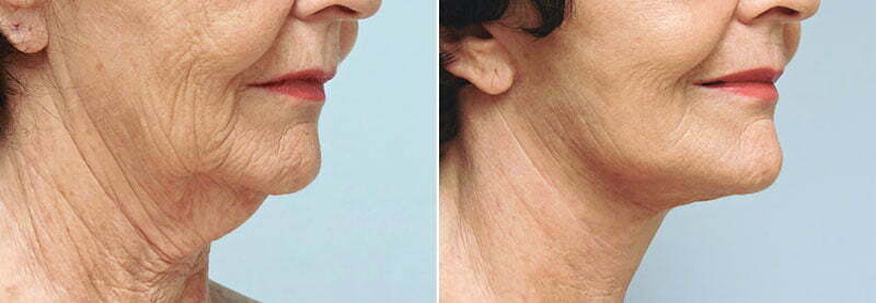 Asheville Neck Lift - Donald Conway, MD, FACS - Neck or Chin ...