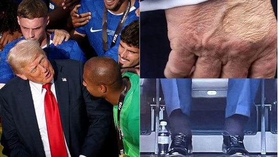 Cardiologist explains possible cause of Donald Trump's swollen ...