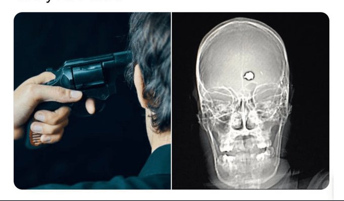 Massimo on X: "In the 1980s, a man with severe OCD shot himself in ...