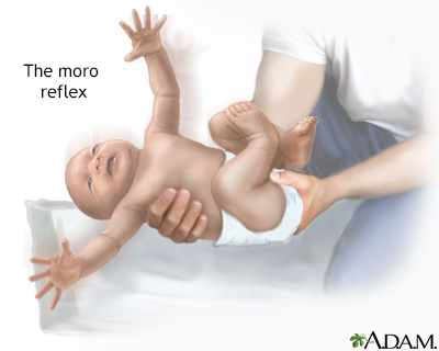 Moro reflex Information | Mount Sinai - New York