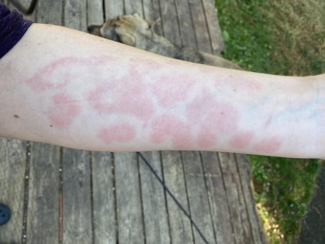 The rash I get when I touch seafood kinda looks like animal print ...