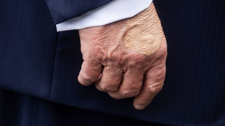 What is chronic venous insufficiency, Trump's diagnosis?