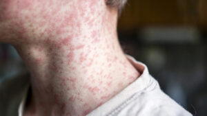 Measles viral disease, human skin covered with measles rash, vaccination concept